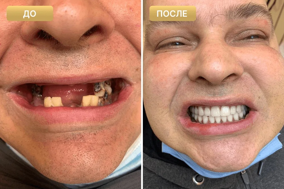 Пациент Full Clinic до и после имплантации при двух оставшихся зубах