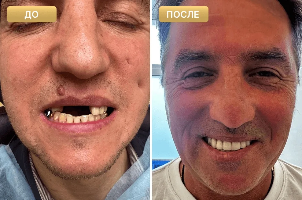 Пациент Full Clinic до и после восстановления верхнего ряда