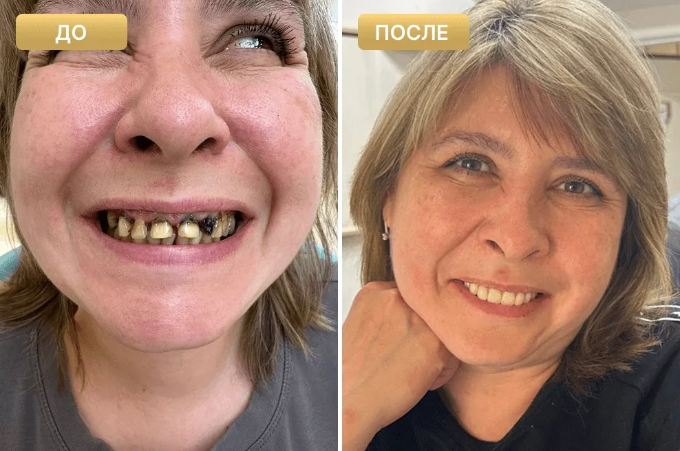 Пациентка Full Clinic до и после имплантации всей челюсти