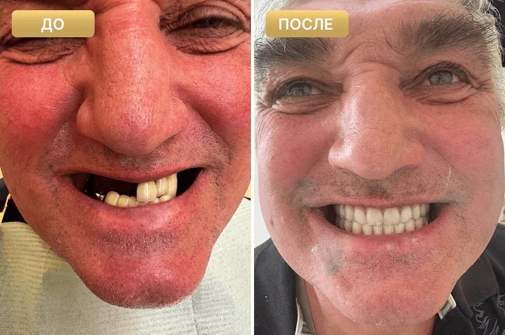 Пациент Full Clinic до и после лечения у главного врача
