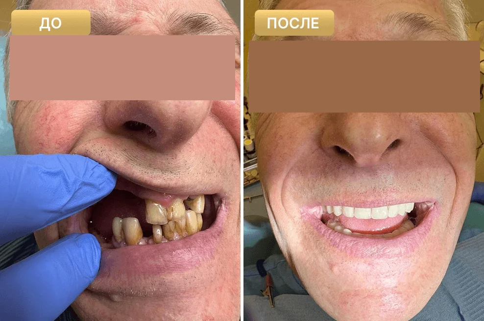 Пациент Full Clinic до и после лечения