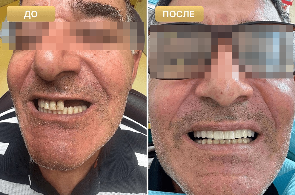 Пациент Full Clinic до и после лечения