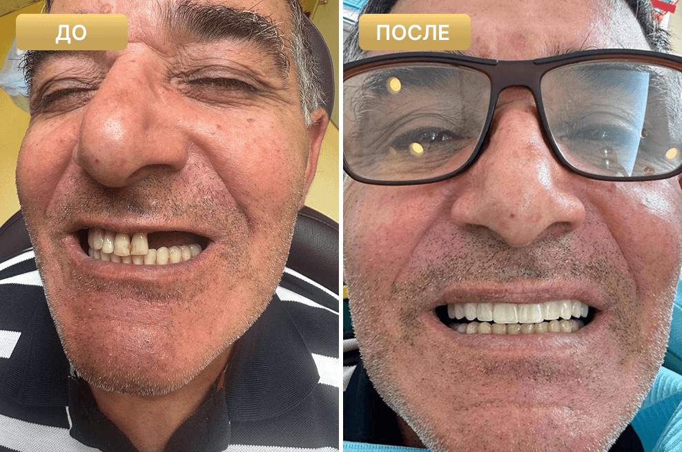 Пациент Full Clinic до и после лечения