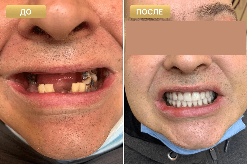Пациент Full Clinic до и после лечения