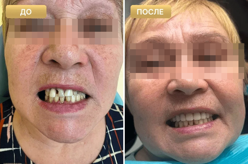Пациент Full Clinic до и после лечения