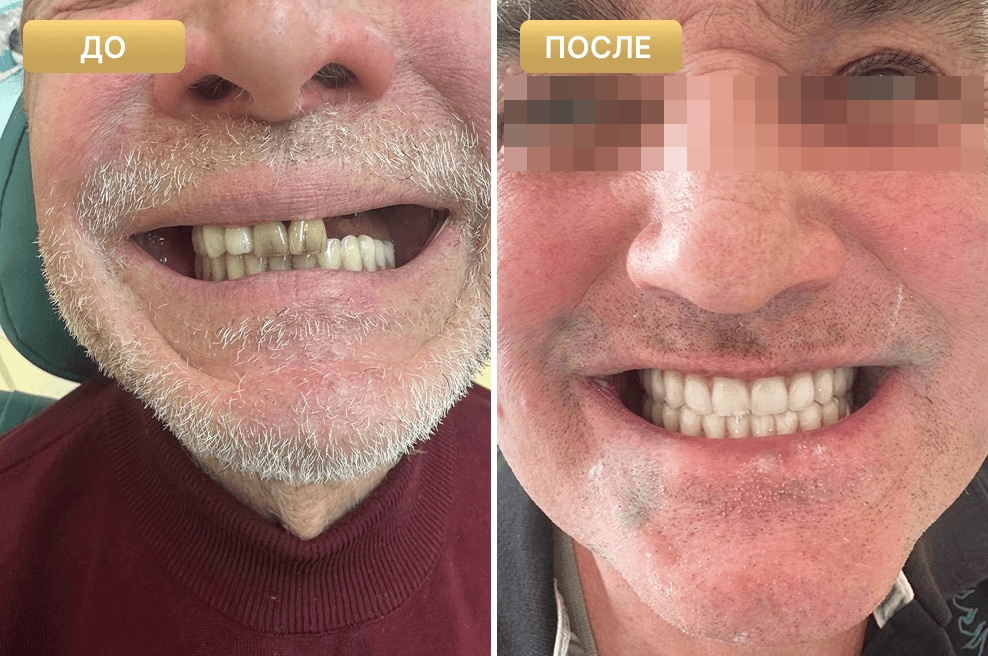 Пациент Full Clinic до и после лечения