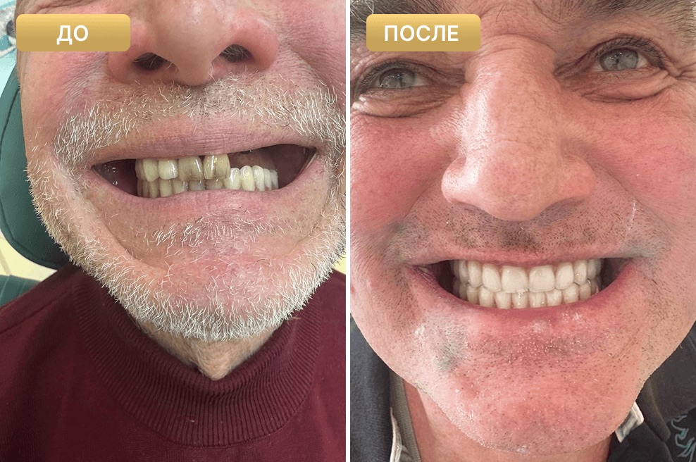 Пациент Full Clinic до и после лечения