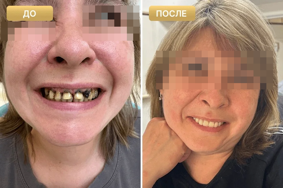 Пациент Full Clinic до и после лечения