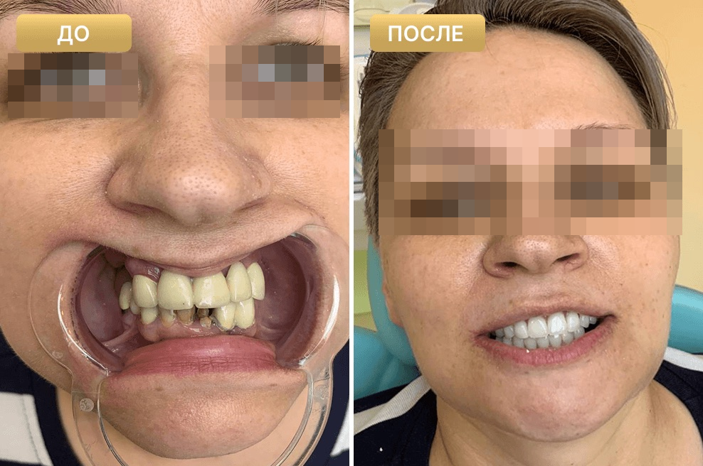 Пациент Full Clinic до и после лечения